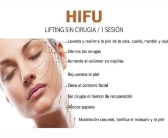 lifting sin cirugia